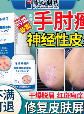 手肘癣手臂胳膊肘肚皮后背顽固性皮癣过敏神经性皮炎搭止痒膏YU