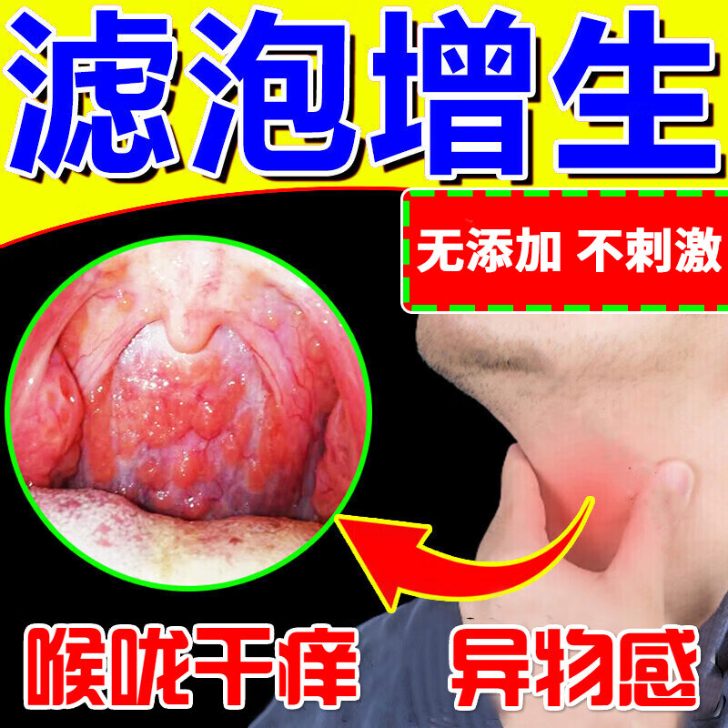 咽炎慢性咽炎除咽喉炎根凝胶液专用喷雾剂滤泡增生日本喷剂烟炎SS