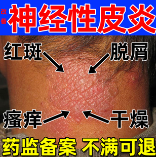 改善神经性皮炎引起红斑瘙痒外用顽固皮肤湿疹搭止痒膏真菌感染E8
