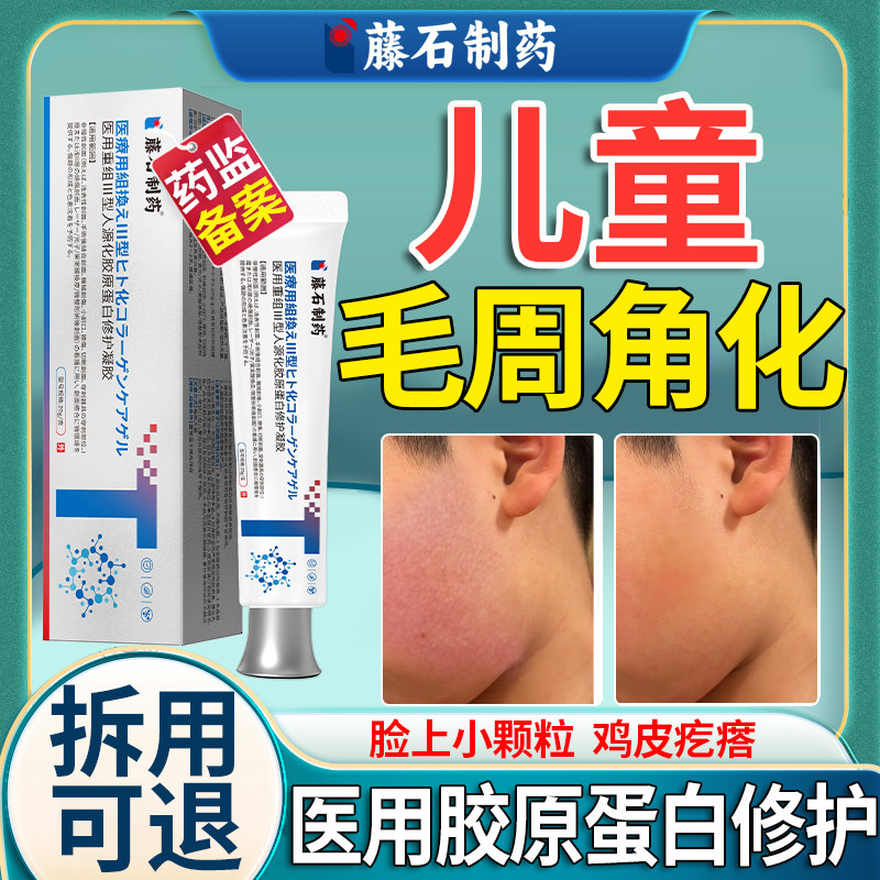 儿童毛囊炎引起毛周角化症脸上有小颗粒脸部鸡皮肤疙瘩毛囊角化HY