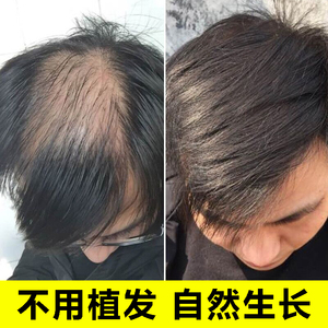 生姜洗发水防脱发生发增发密发男女士快速头发增长液头发变多变密