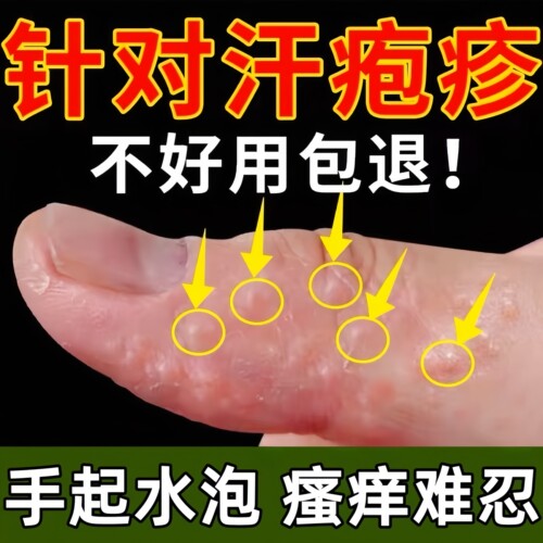 【专攻汗疱疹】手上起小水泡软膏