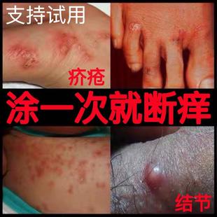 疥疮膏结不油腻去除阴虱疥虫螨私处止痒儿童成人疥苍特效专用药