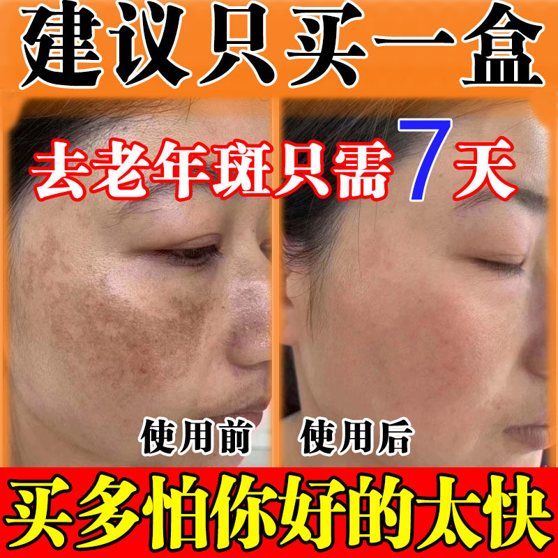 祛斑专用药水一擦就掉老年斑强力去除分解黑色素精华液正品