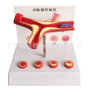 支脉粥样硬化 心血管动脉硬.化模型 血栓.形成模型人体血管模型