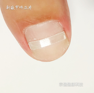 包邮宗健嵌甲矫正矫形弹性贴片指甲扎肉卷曲变形内生嵌甲沟拉力贴