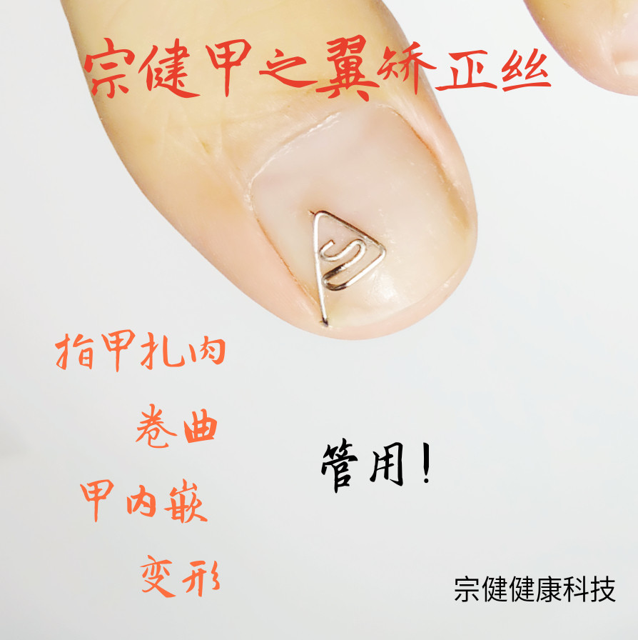 包邮宗健嵌甲矫正丝 单侧矫形 拇指小趾2345指甲指甲扎肉卷曲变形