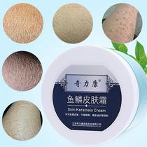 奇力康鱼鳞皮肤霜蛇皮肤小腿部上干燥蜕皮鸡皮全身身体乳去死皮