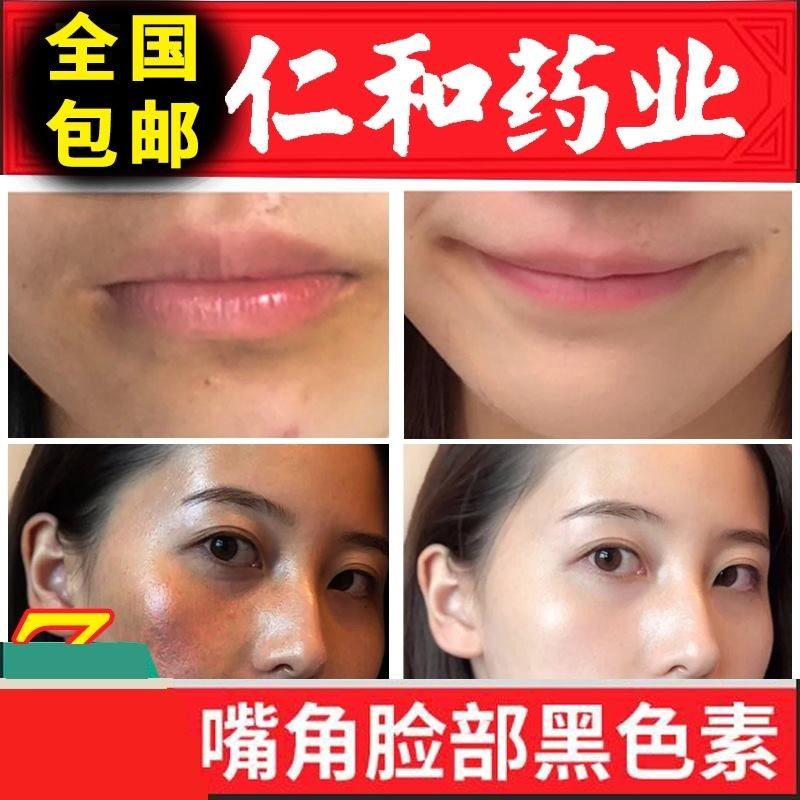 嘴角发黑嘴唇部去黑去除下巴唇周围角边改善美白暗沉淡化唇纹