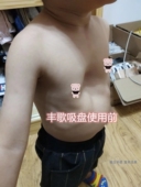 青岛丰歌漏斗胸矫正器负压吸盘儿童款 中国专利七天试戴厂家直销