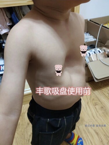 青岛丰歌漏斗胸矫正器负压吸盘儿童款中国专利七天试戴厂家直销 - 封面