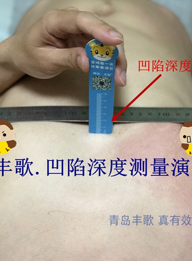 漏斗胸漏斗胸吸盘矫正丰歌准确胸