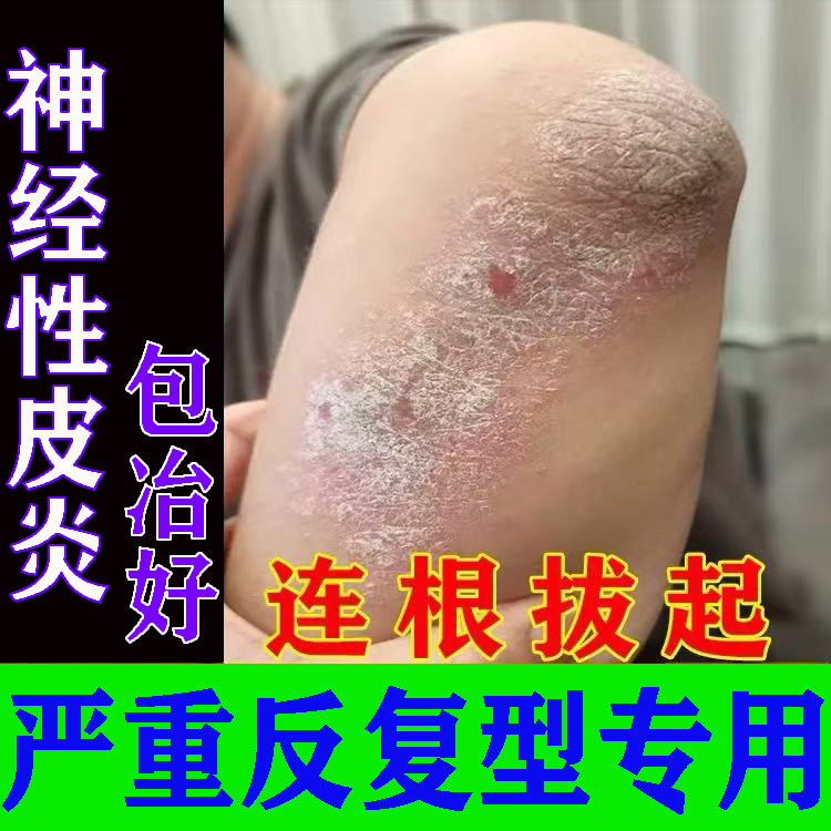 神经性皮炎治疗去外根用除膏顽固祛皮肤湿特病疹效脸面头部脂溢性