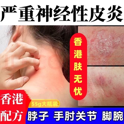 香港进口配方】神经性皮炎特效膏