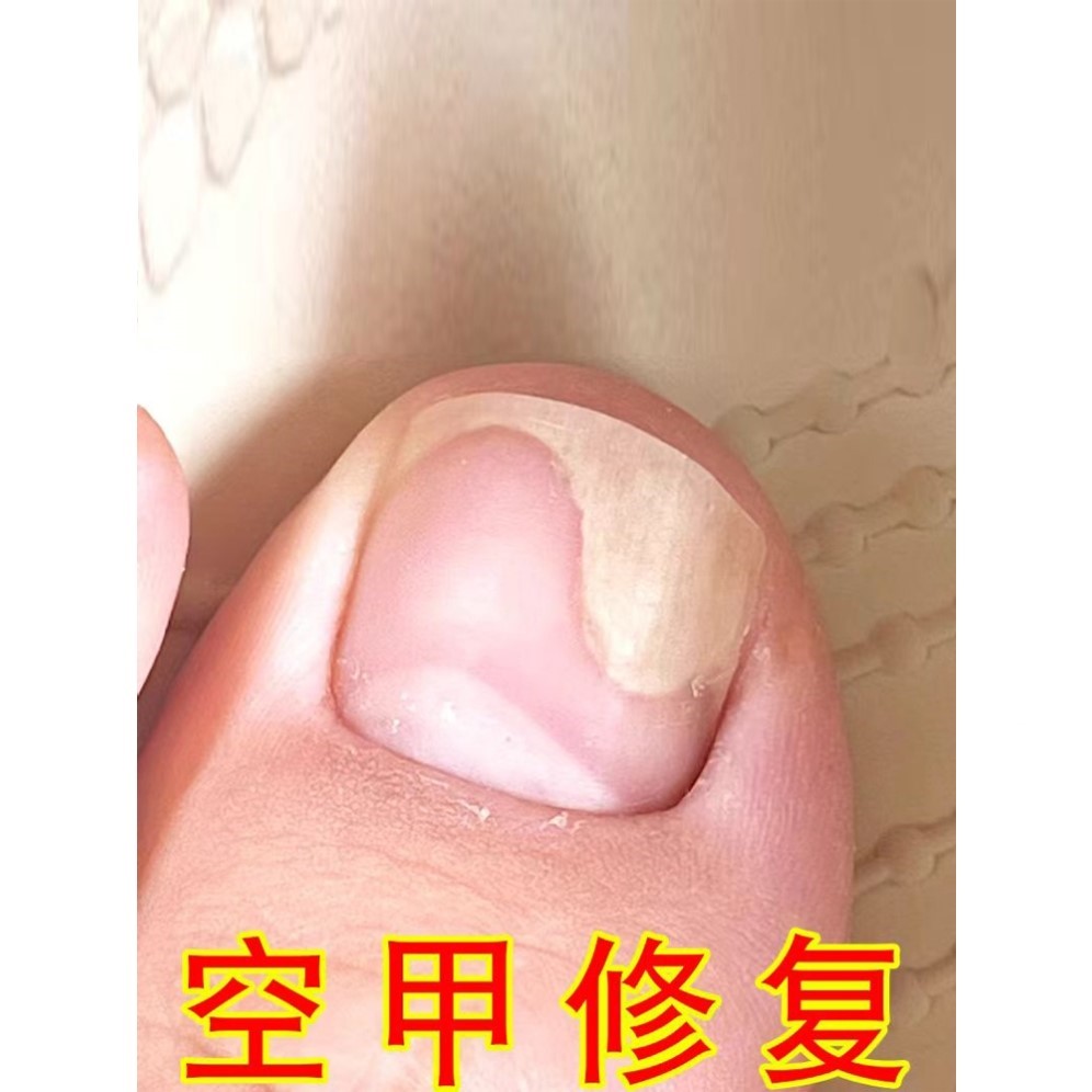 治指甲修复液受损再生甲床甲肉分离空甲专分层养剥增长手脚趾用药