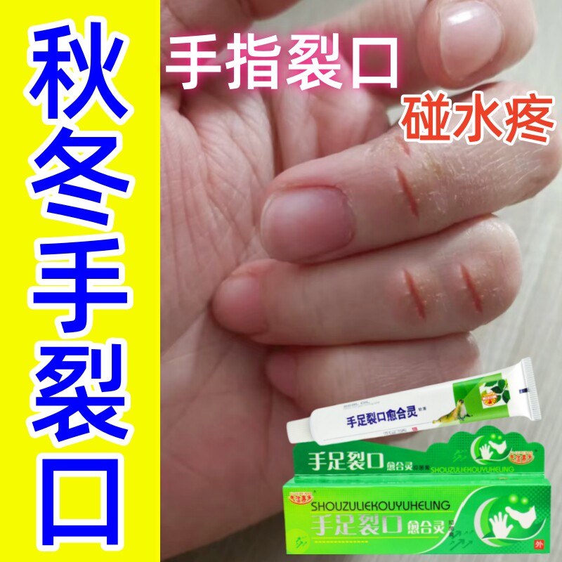 手严重裂口药膏手指严重裂口指甲缝裂口干裂防皲裂开裂愈合修复霜