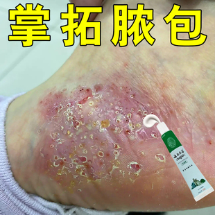 掌趾脓疱病专用膏掌跖脓包角化病症疗手脚脱皮干裂角皮症