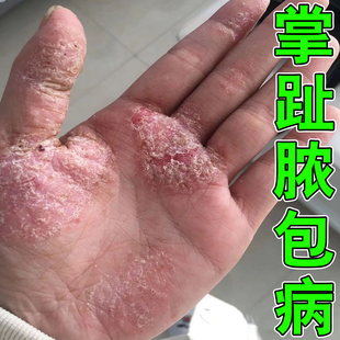 掌趾脓疱病专用掌跖角化症手脚脓包蜕皮干裂角皮症外用膏