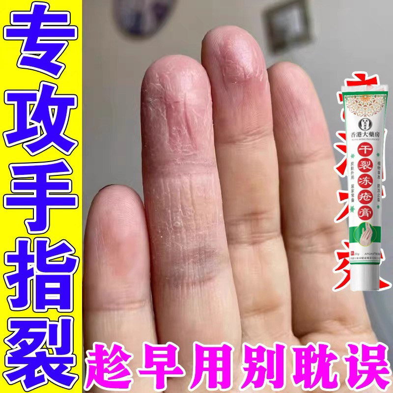 手指头裂口子脱皮手指缝开裂指尖裂口冬季手干裂滋润保湿软膏