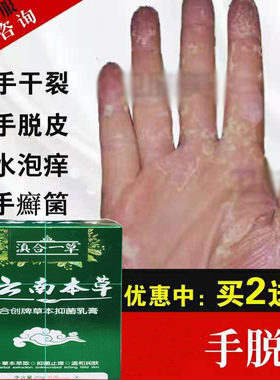 治手脚水泡脱皮药皮肤抑菌止痒膏