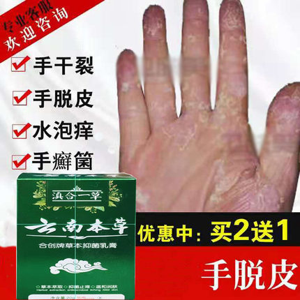 合创牌治手脚皮肤止痒脱皮药杀菌真菌水泡烂脚丫痒脚臭脚汗脚痒膏