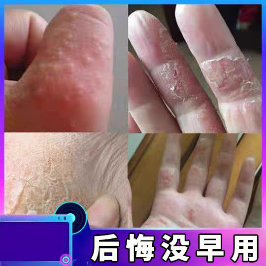 治手足脱皮干裂药水泡痒季节性蜕皮爆皮起水泡痒过敏止痒膏反复药