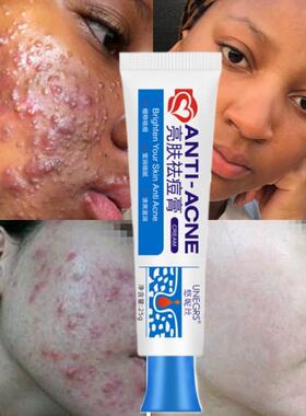 New Powerful Acne Removal Face Cream Clears Pimple Scar Blac