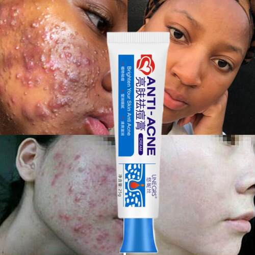 New Powerful Acne Removal Face Cream Clears Pimple Scar Blac