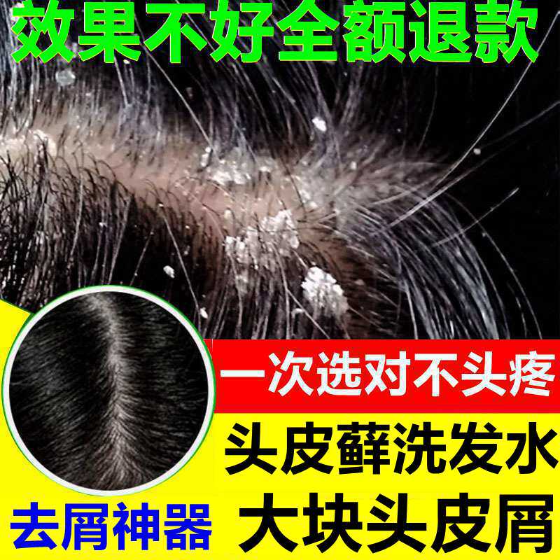 大块头皮屑神器去头屑除头螨去屑止痒洗发水控油正品修研抑菌洗液