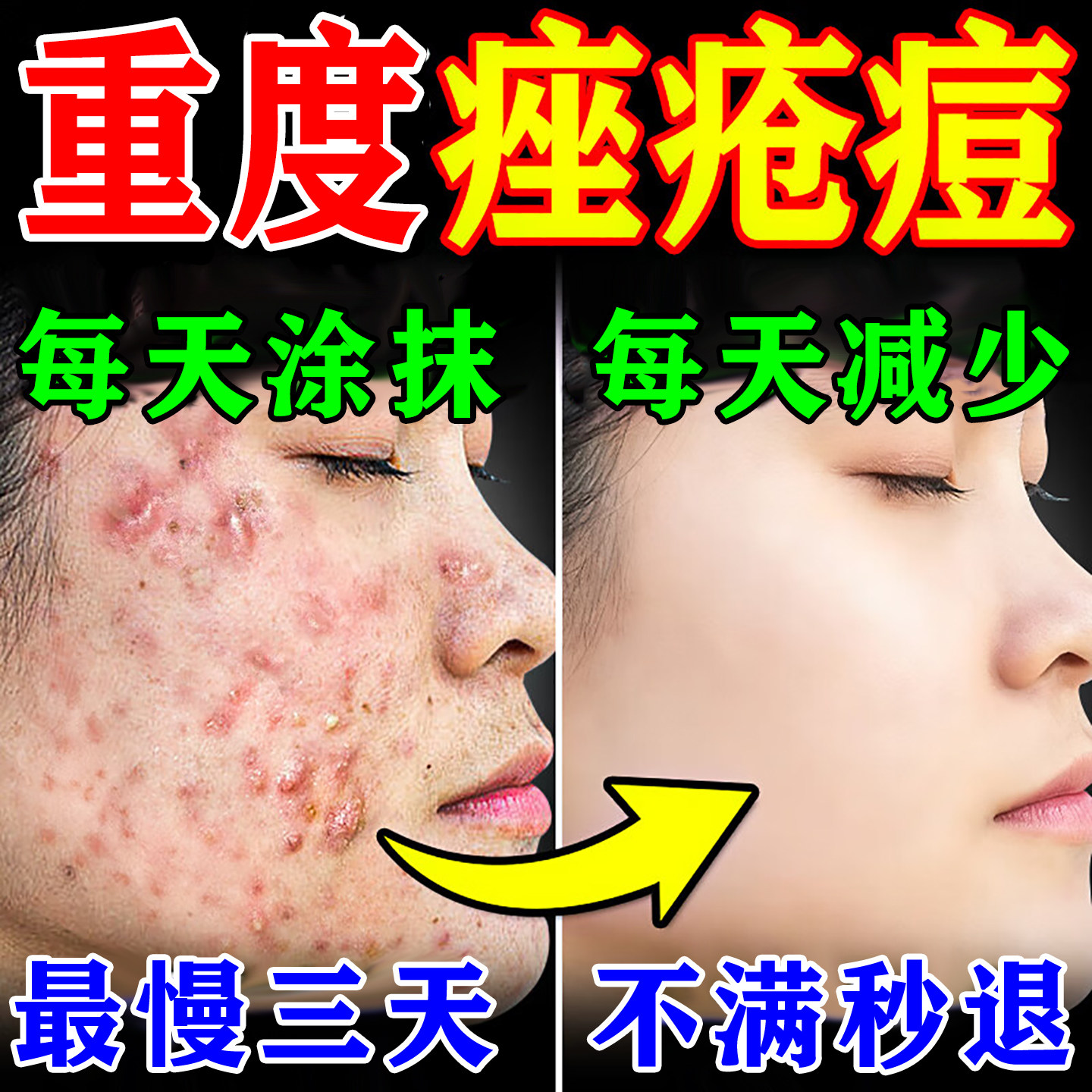 重度玫瑰痤疮膏药特去青效春痘暗疮祛痘印粉刺闭口屏障修复涂膜剂