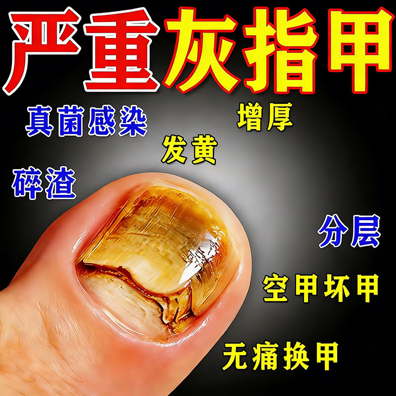 亮甲灰指甲专用膏药贴抑菌液指甲剪刀真菌感染杀菌液去坏甲磨器锉