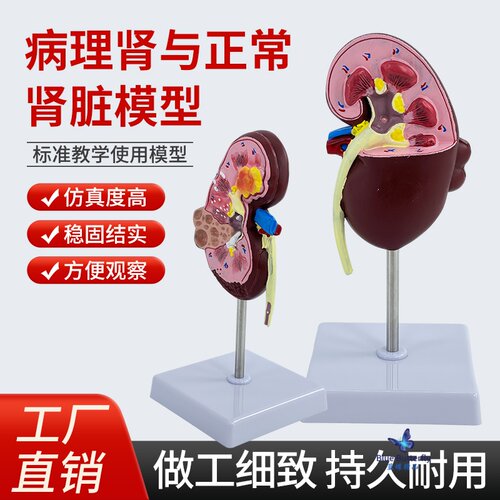 蓝蝶模型病变与正常肾脏解剖