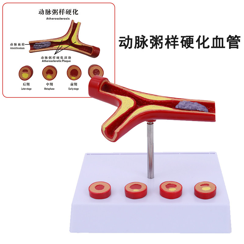 蓝蝶人体血管硬化动脉粥样化血管