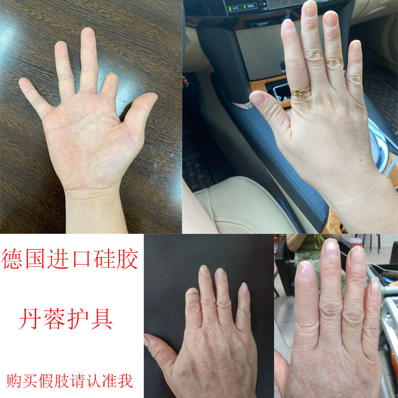 假肢假手指仿真脚趾残疾人义肢半指德国进口硅胶美容手套量身定做