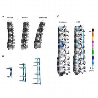 医学有限元分析 生物力学彷真模拟 Ansys Workbench有限元分析.