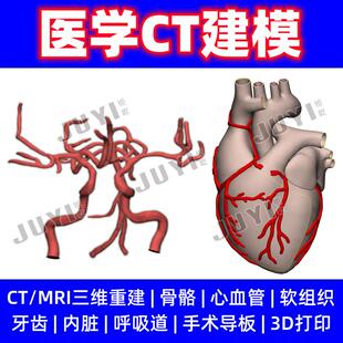 CT三维重建/医学模型建模/3D打印动静脉血管/心脏冠脉/主动脉瓣膜