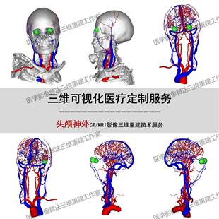 Mimics头颅神外CTA医学影像重建DCM影像STL NII文件三维可视化