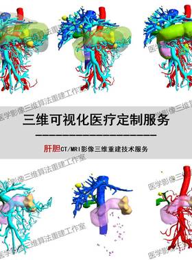 Mimics肝胆CT MRI医学三维重建DICOM影像STL NII三维可视化3D打印