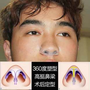 鼻小柱支撑器矫正定型抬高夹鼻翼鼾鼻孔腔止鼾器支撑呼吸扩展透气