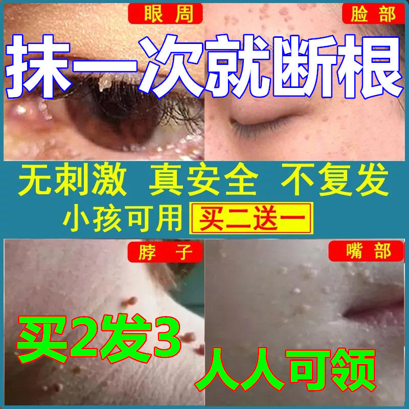 草本克疣霜液无痛去除脖子丝状疣去尤灵腋下肉粒皮赘猴子疣克舒膏