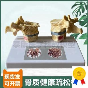 人体骨骼模型脊椎骨m质密度疏松老年人骨骼椎间盘压迫神经演示病