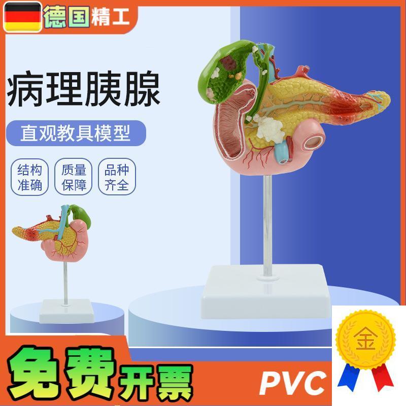 德国】教学仿真病变胰脾肝胆十二指肠模型病理胰W腺标本胰脾肝