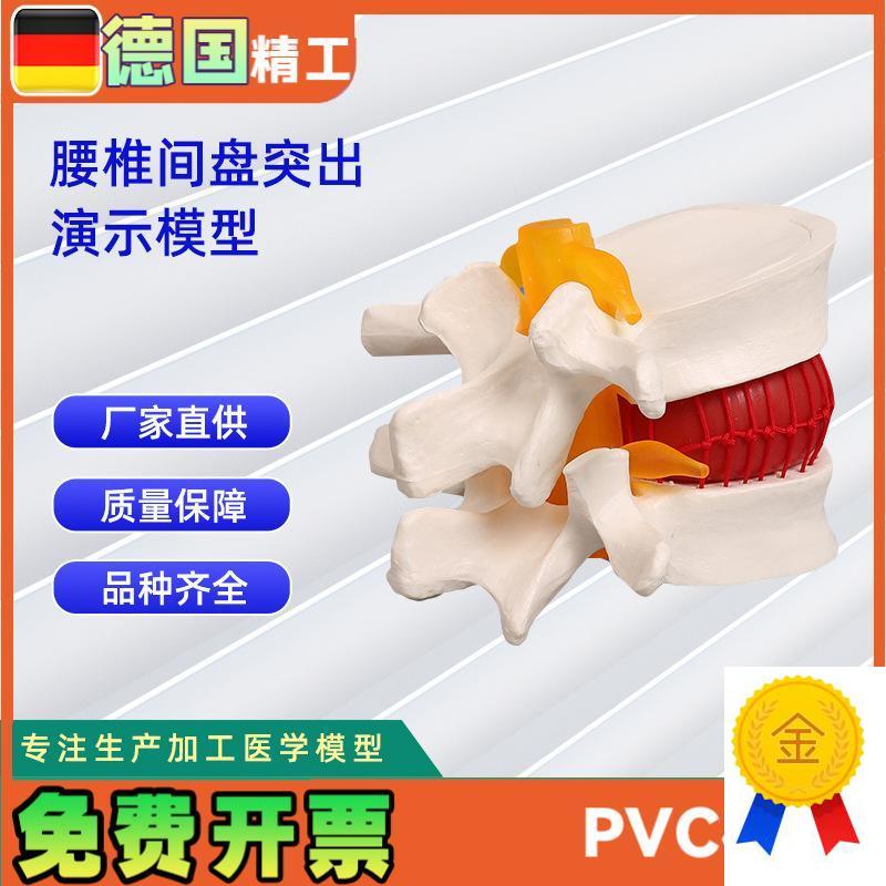 椎间盘模型人体腰椎突出病理演示模型11*10X*7.6CM