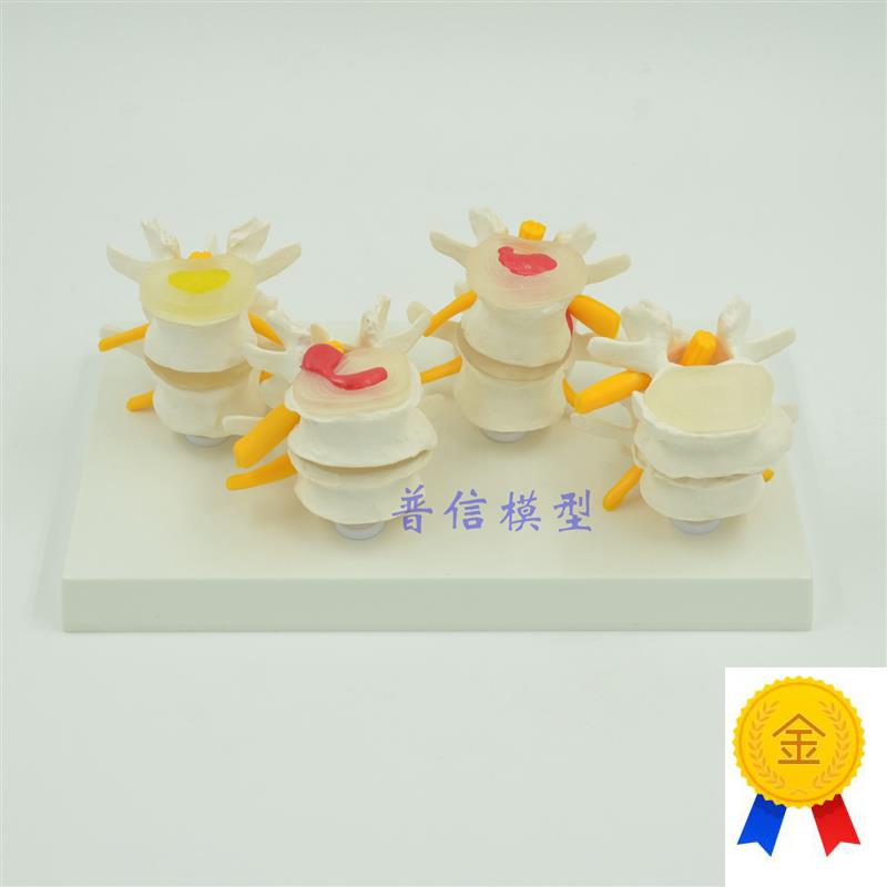 普信人体骨骼人体模型骨科教学医用脊椎模型X病变腰椎模型
