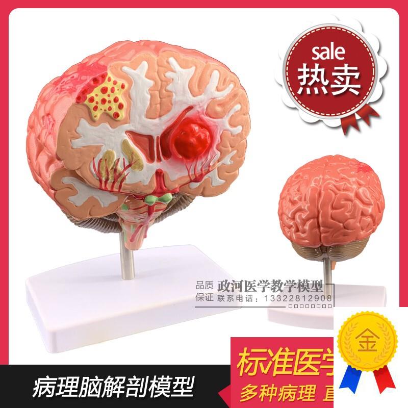 仿真人体脑部疾j病模型大脑解剖神经内外科脑病理大脑病变模型