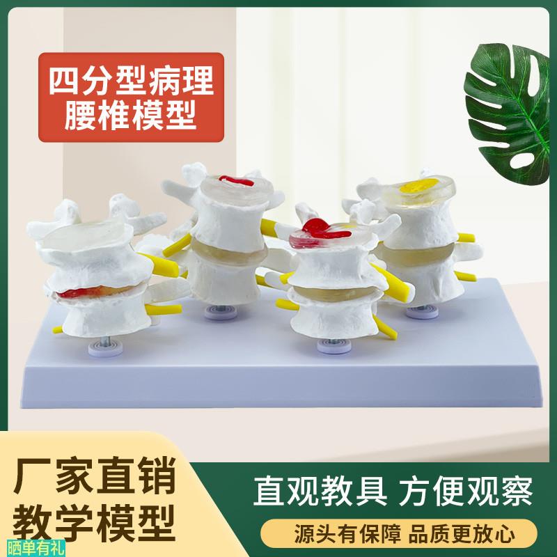 四分型脊椎正常与病变腰椎组合模型 椎间盘病理腰椎演示过程 病变