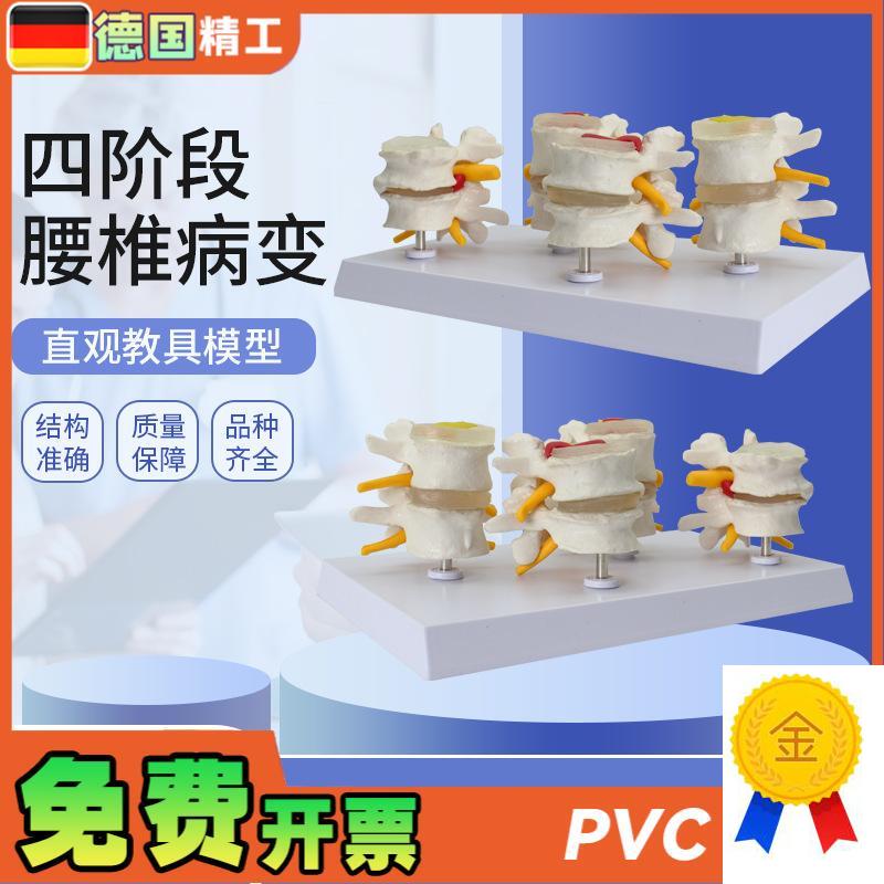 德国】人体腰椎模型四阶段腰椎对比椎间盘突P出脱出演示模型骨科