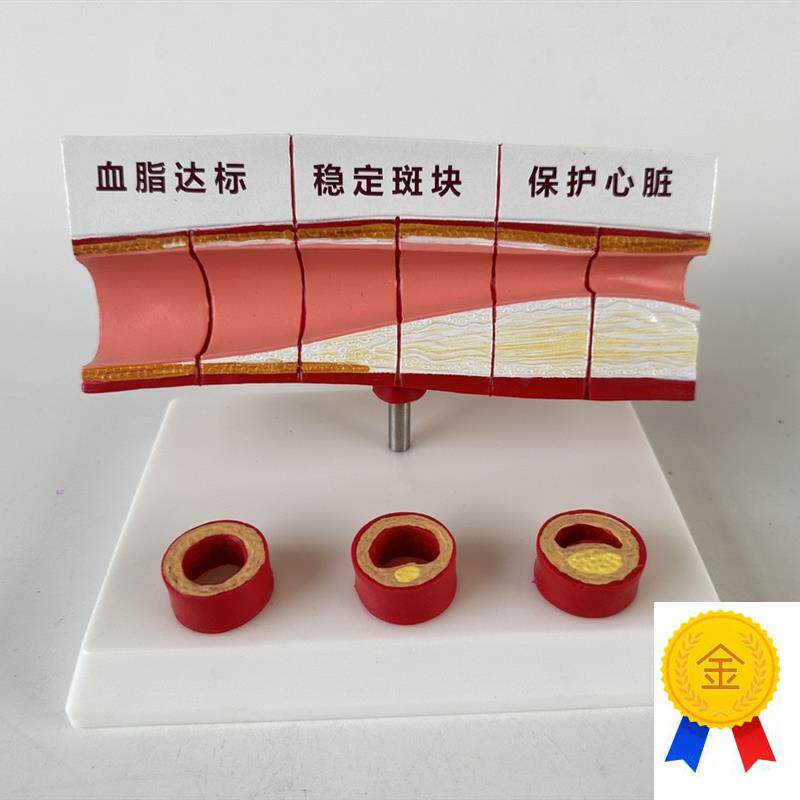 血管/堵塞动f支脉粥样/硬化心血管动脉/硬化模型血管病理模型血栓
