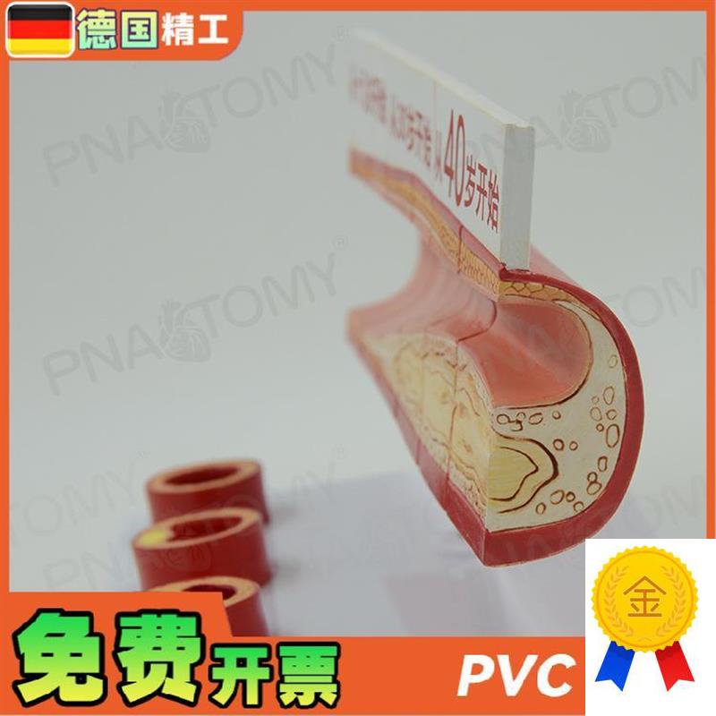 德国】人a体血脂胆固醇与年龄模型guan心病血栓过程模动脉医学