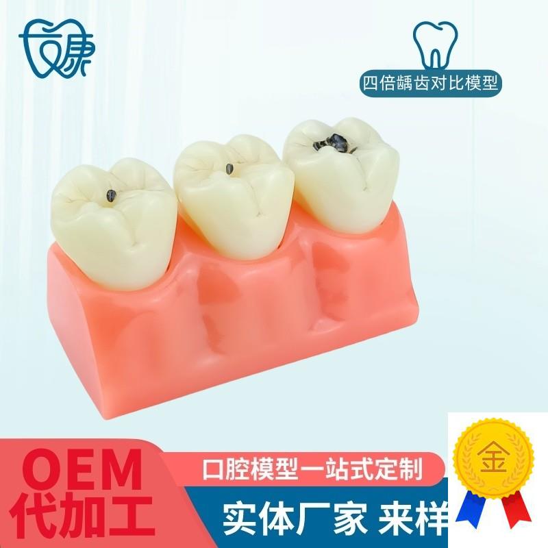 牙模型牙科口腔教学模s型窝沟封闭模型龋齿对比模型龋齿模型